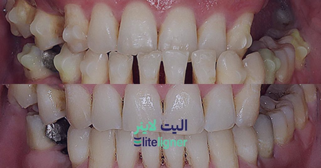 رقع لقی دندانها