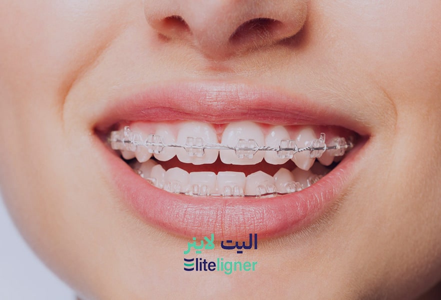 ارتودنسی نامرئی با براکت سرامیکی