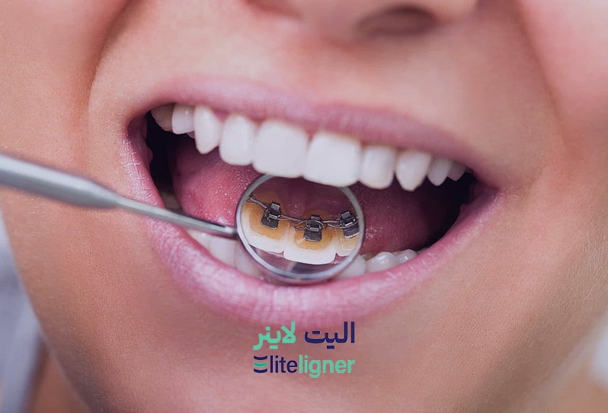 ارتودنسی نامرئی لینگوال