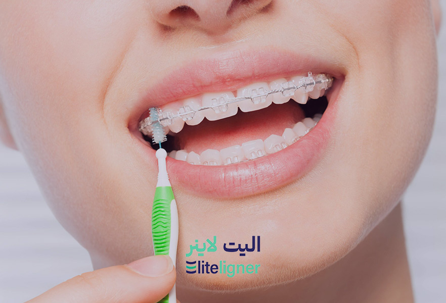 ارتودنسی نامرئی سرامیکی