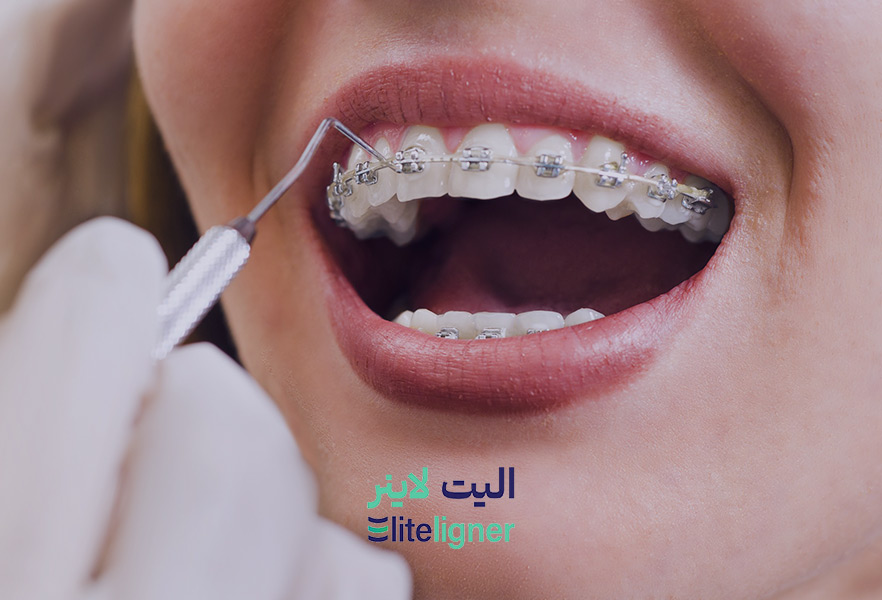 ارتودنسی ثابت فلزی در کرمان
