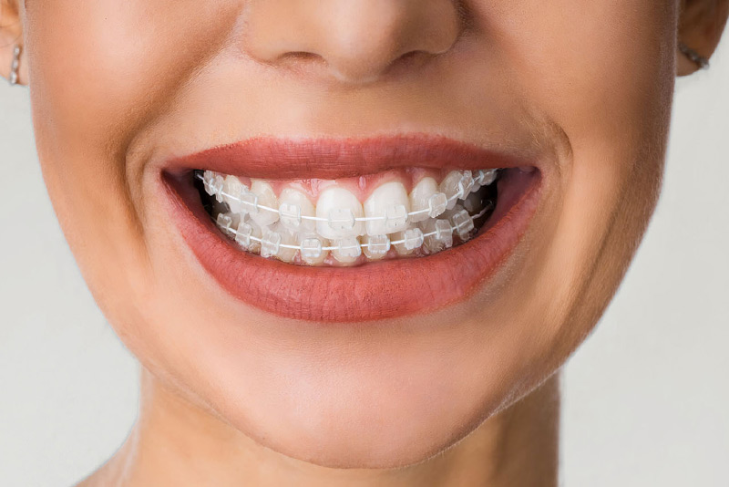 ارتودنسی نامرئی ثابت چیست؟